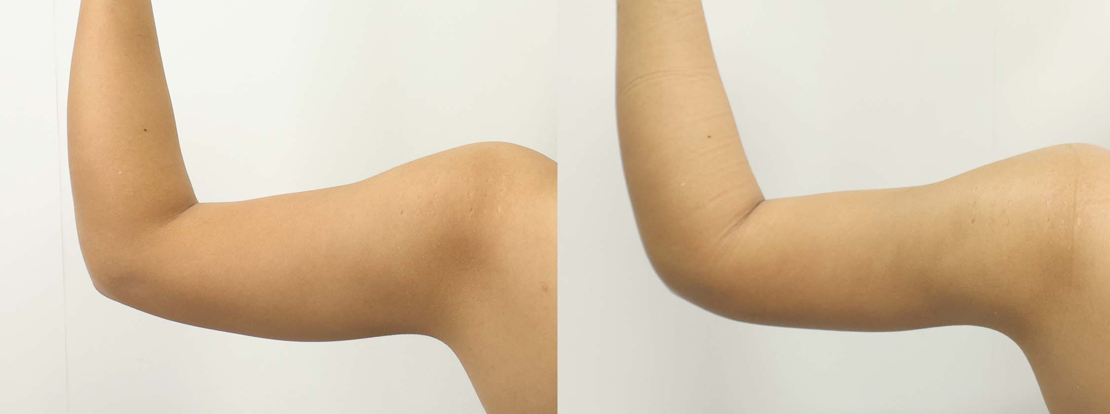 体の脂肪吸引の症例写真 施術前後 1ヵ月