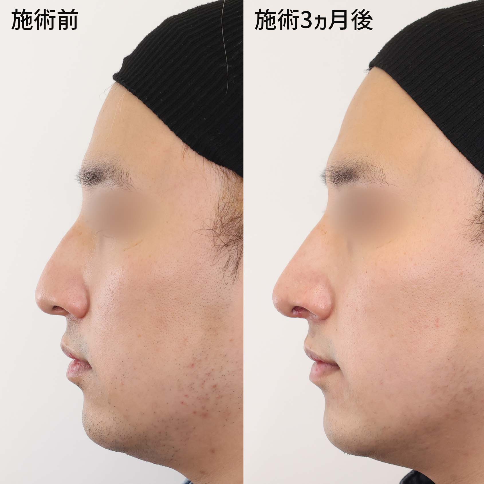 変わる 形 鼻 の 鼻を小さくする方法！鼻が大きいのは改善できる！美容家の教える簡単ケア