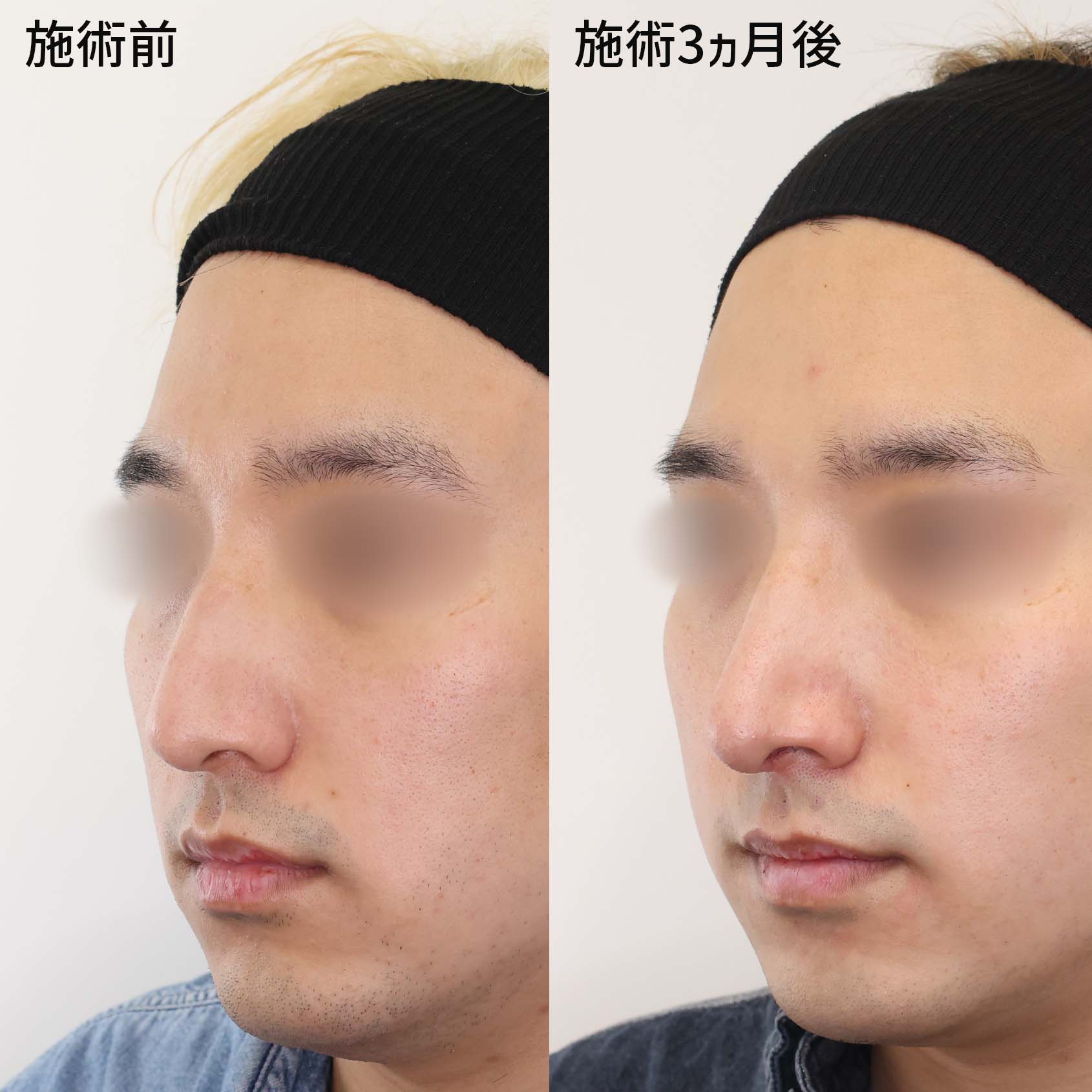 鼻中隔延長術/鼻尖形成・鼻尖縮小/鼻先軟骨移植の症例写真 施術前後