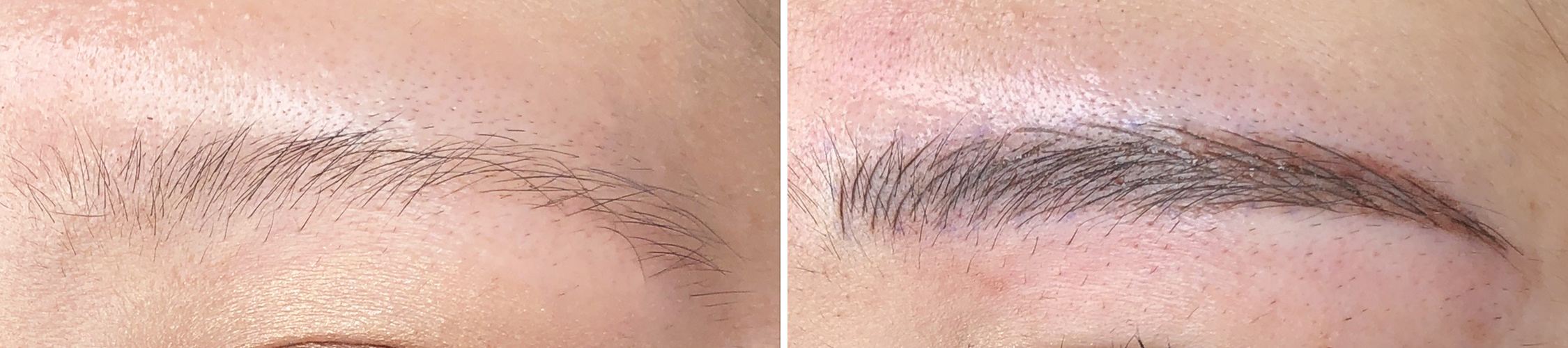 TACメディカルアートメイク（眉・アイライン・リップ）の症例写真 施術前後 直後