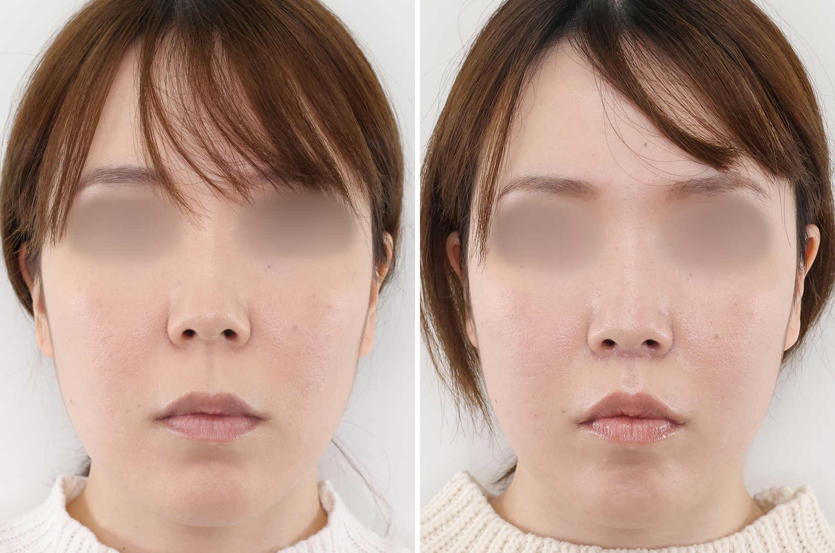 人中短縮術(リップリフト)・外側人中短縮術/口角挙上・リフト（マイクロ切開法・内側法/口内法）の症例写真 施術前後 