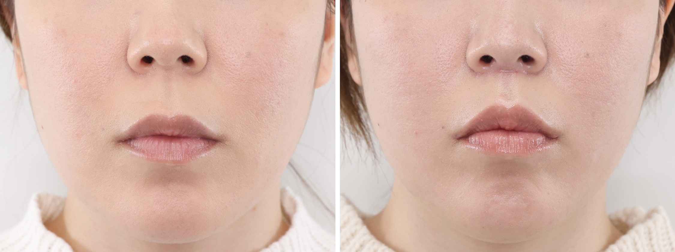 人中短縮術(リップリフト)・外側人中短縮術/口角挙上・リフト（マイクロ切開法・内側法/口内法）の症例写真 施術前後 