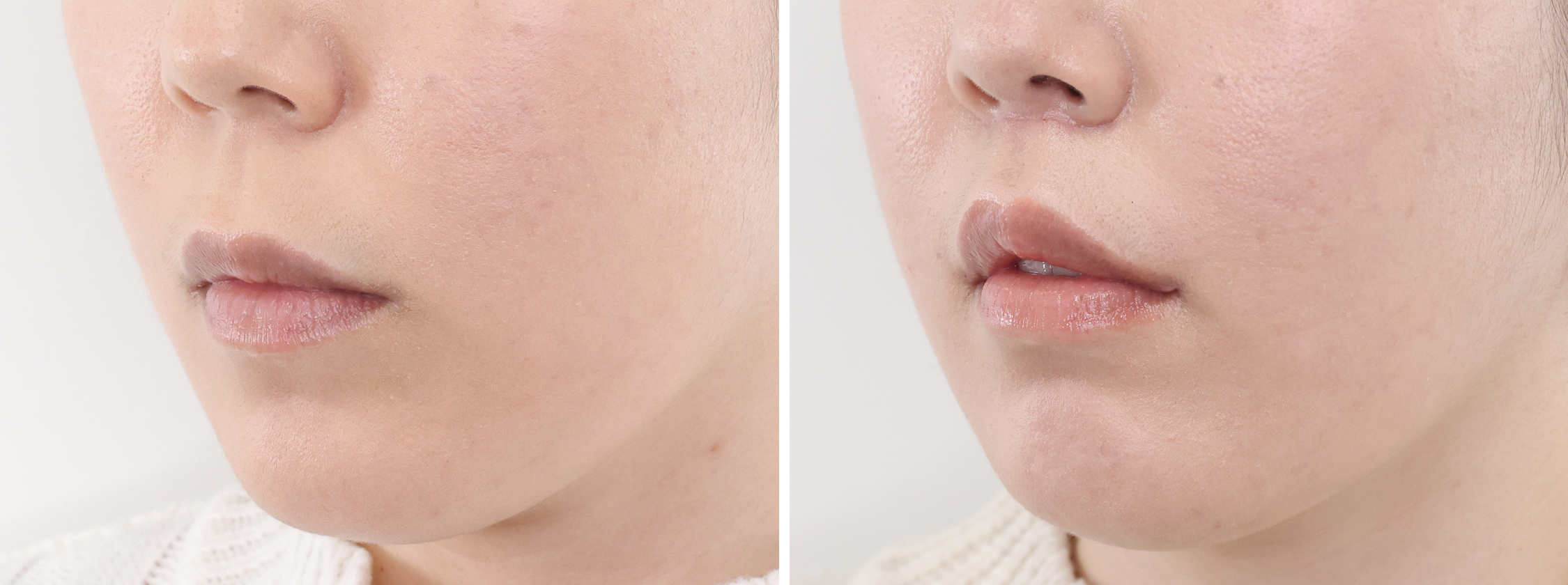 人中短縮術(リップリフト)・外側人中短縮術/口角挙上・リフト（マイクロ切開法・内側法/口内法）の症例写真 施術前後 
