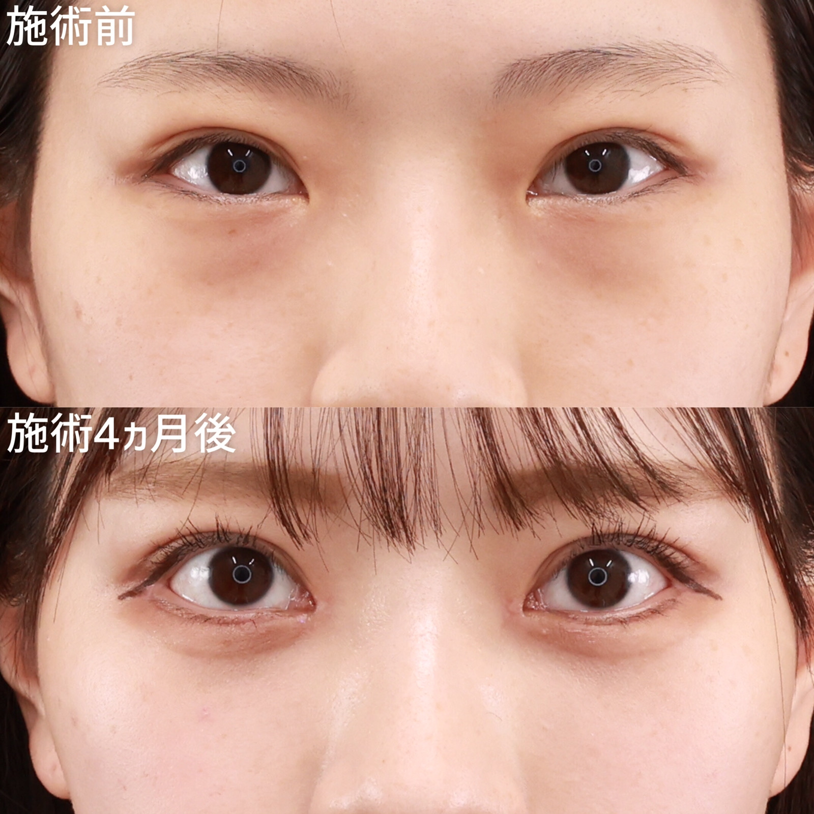【下眼瞼脱脂術+脂肪注入+グラマラスライン+目頭切開】目元複合オペもお任せください!