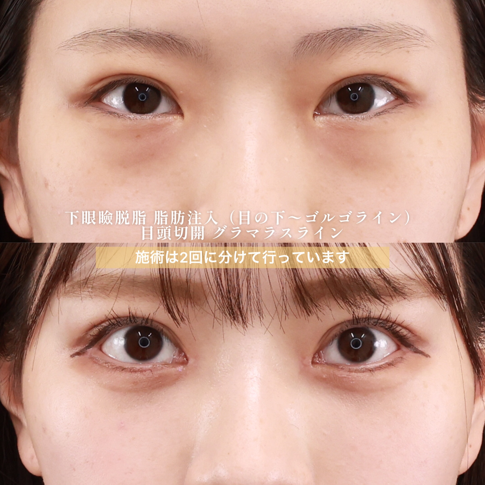 下眼瞼脱脂術(目の下のたるみ取り・目の下の脂肪ふくらみ取り)/顔の脂肪注入(コンデンスリッチフェイス)/目頭切開術の症例写真 施術前後