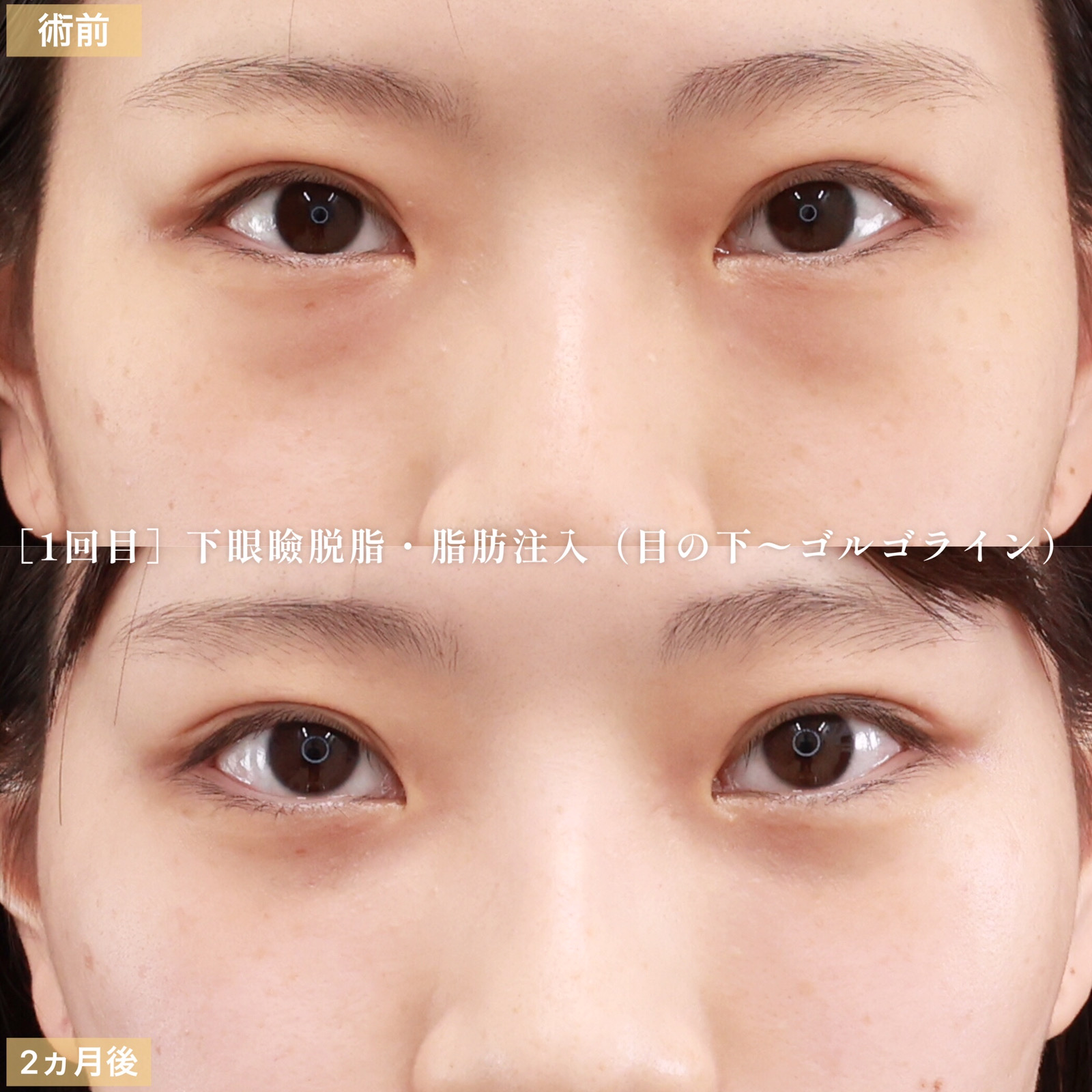 下眼瞼脱脂術(目の下のたるみ取り・目の下の脂肪ふくらみ取り)/顔の脂肪注入(コンデンスリッチフェイス)/目頭切開術の症例写真 施術前後