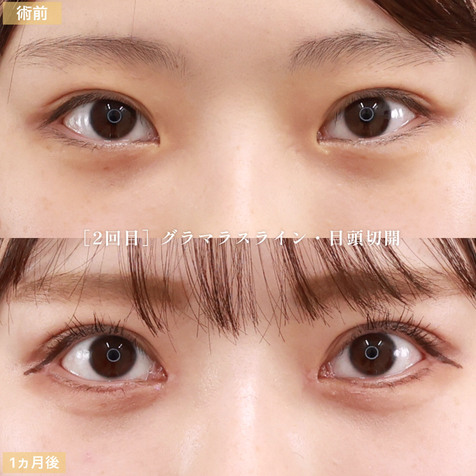 下眼瞼脱脂術(目の下のたるみ取り・目の下の脂肪ふくらみ取り)/顔の脂肪注入(コンデンスリッチフェイス)/目頭切開術の症例写真 施術前後