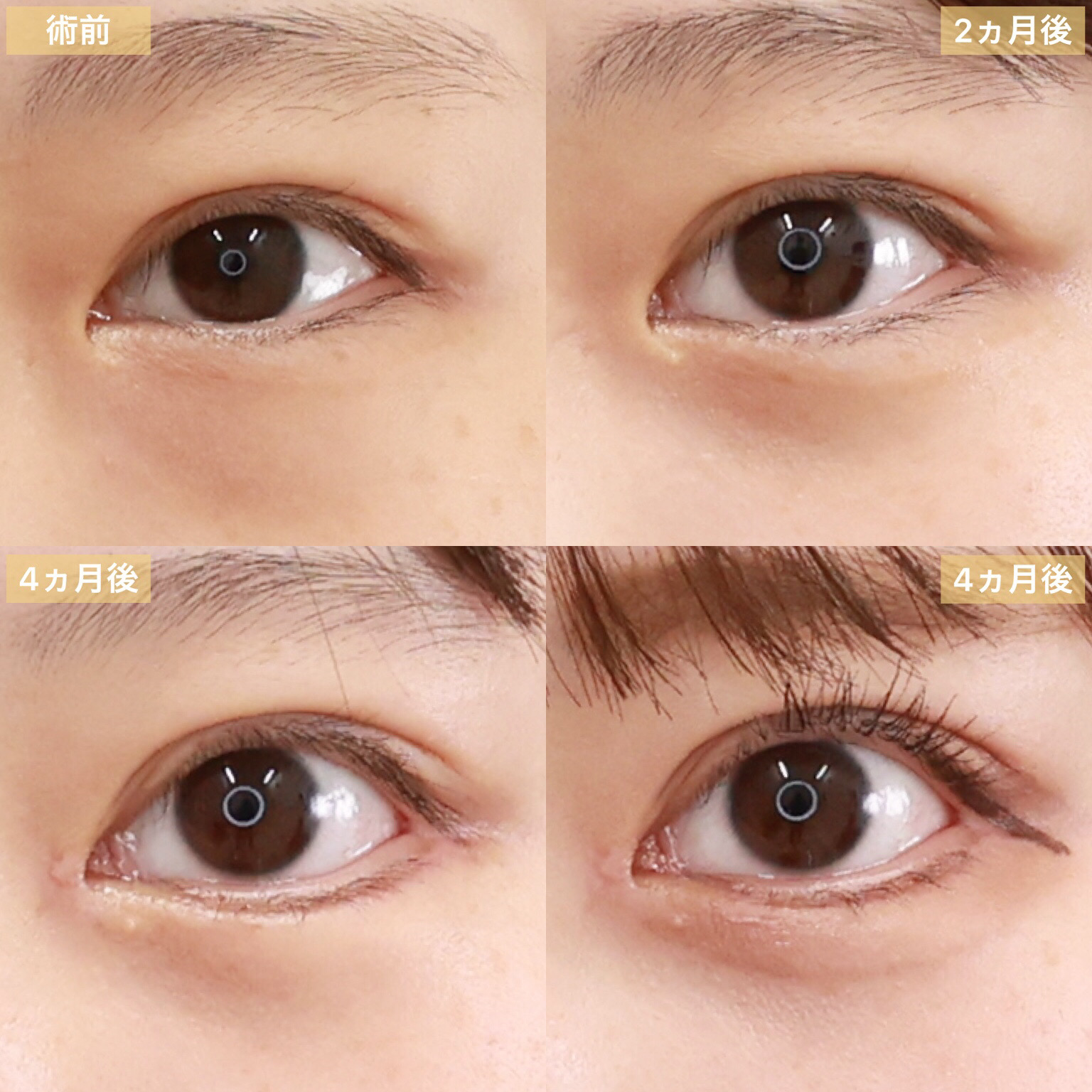 下眼瞼脱脂術(目の下のたるみ取り・目の下の脂肪ふくらみ取り)/顔の脂肪注入(コンデンスリッチフェイス)/目頭切開術の症例写真 施術前後