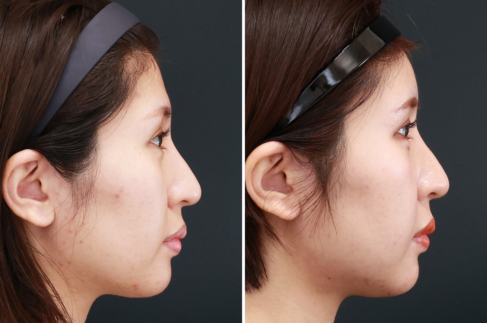 おでこの脂肪注入（オルチャンデコ形成）/顔の脂肪注入(コンデンスリッチフェイス)の症例写真 施術前後 1ヵ月
