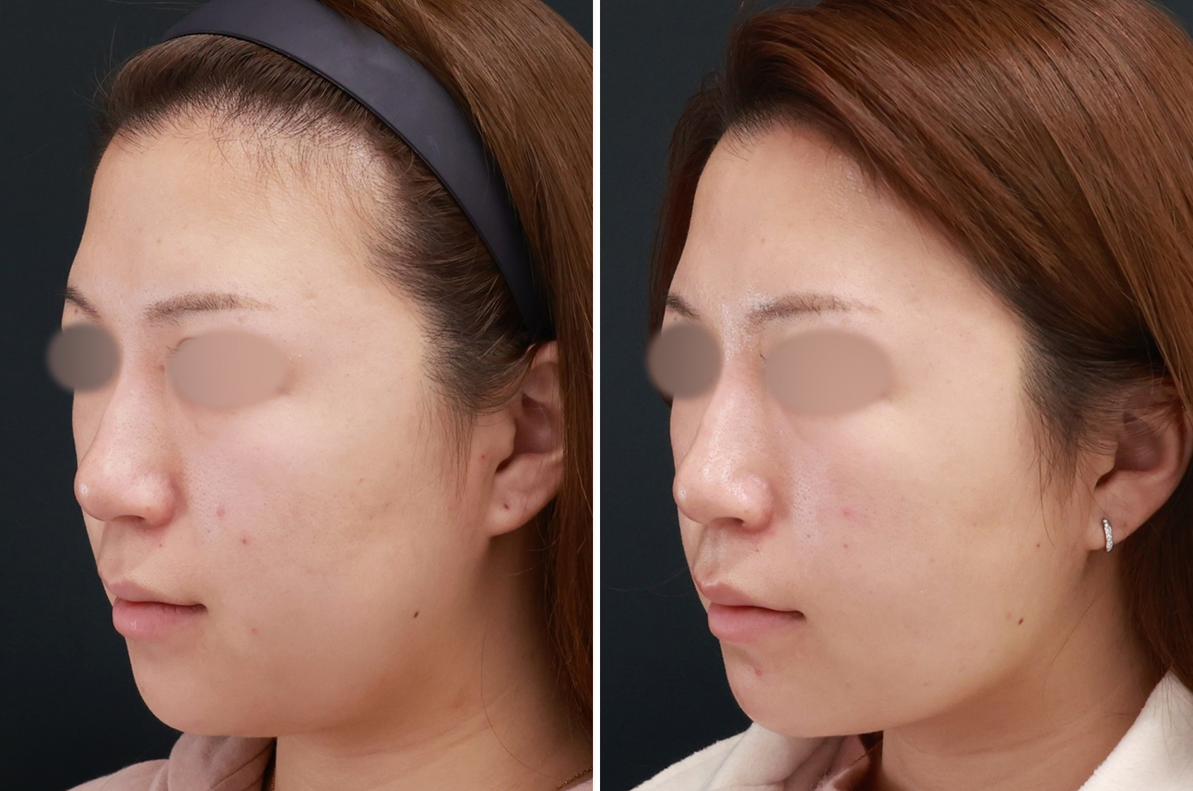 顔の脂肪吸引/TAC式 ツヤ肌コラーゲンリフト®の症例写真 施術前後 1ヵ月