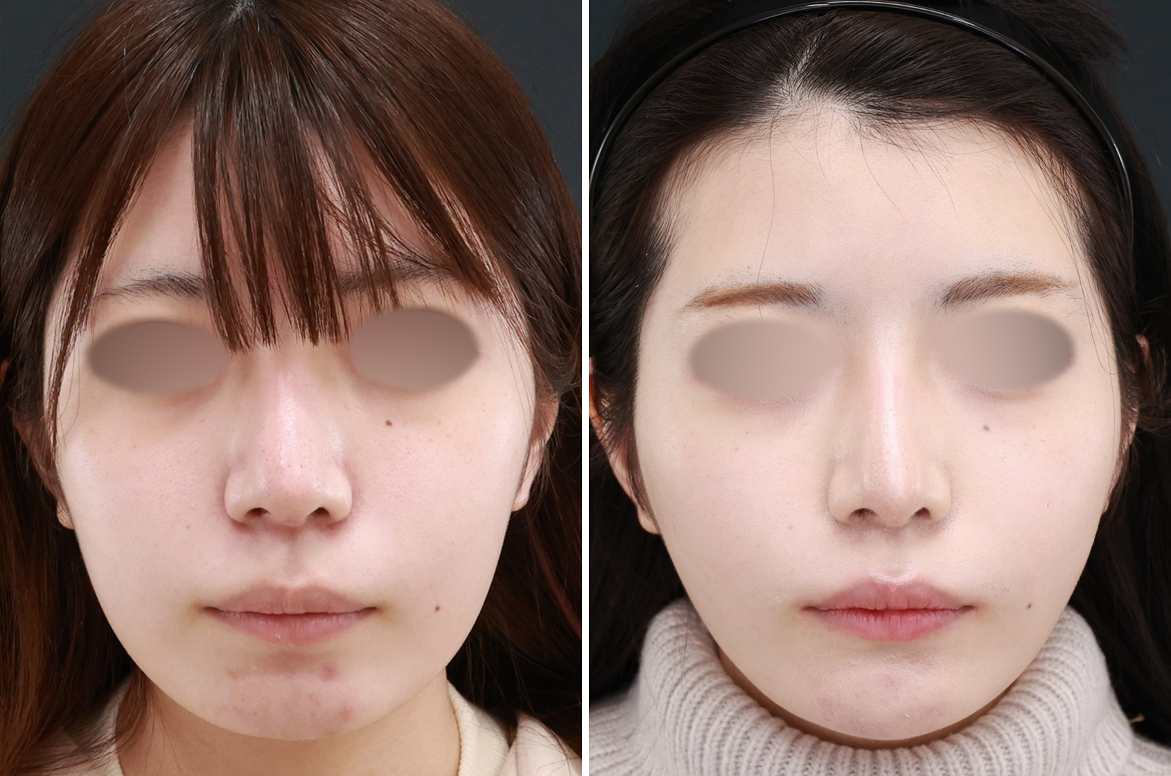 他院で脂肪吸引したけど…まだ小顔になりたい!!そんな方に『 TAC式ツヤ肌コラーゲンリフト極』