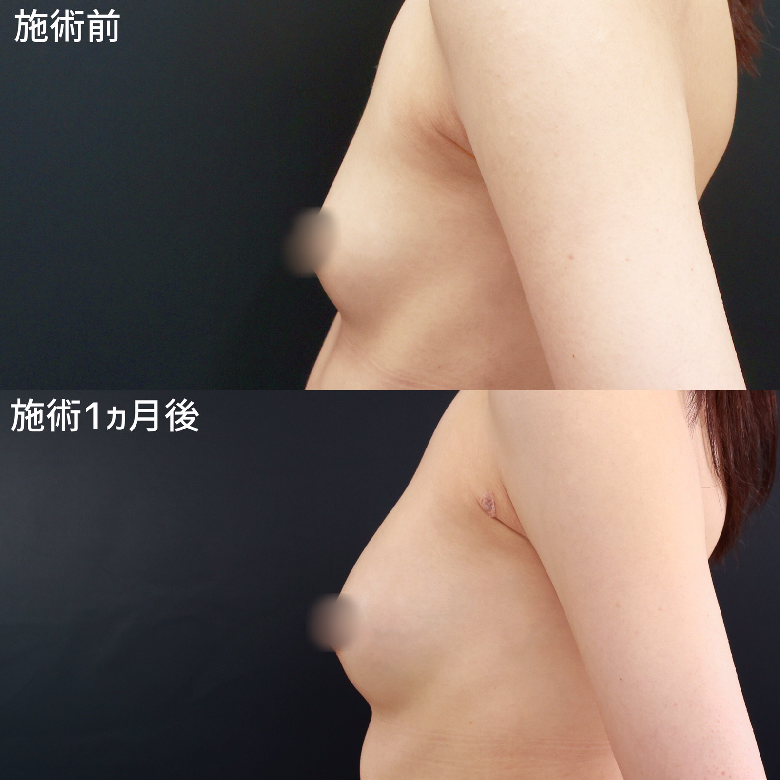 脂肪注入豊胸（コンデンスリッチ・ピュアグラフト・１day脂肪豊胸）の症例写真 施術前後 1ヵ月