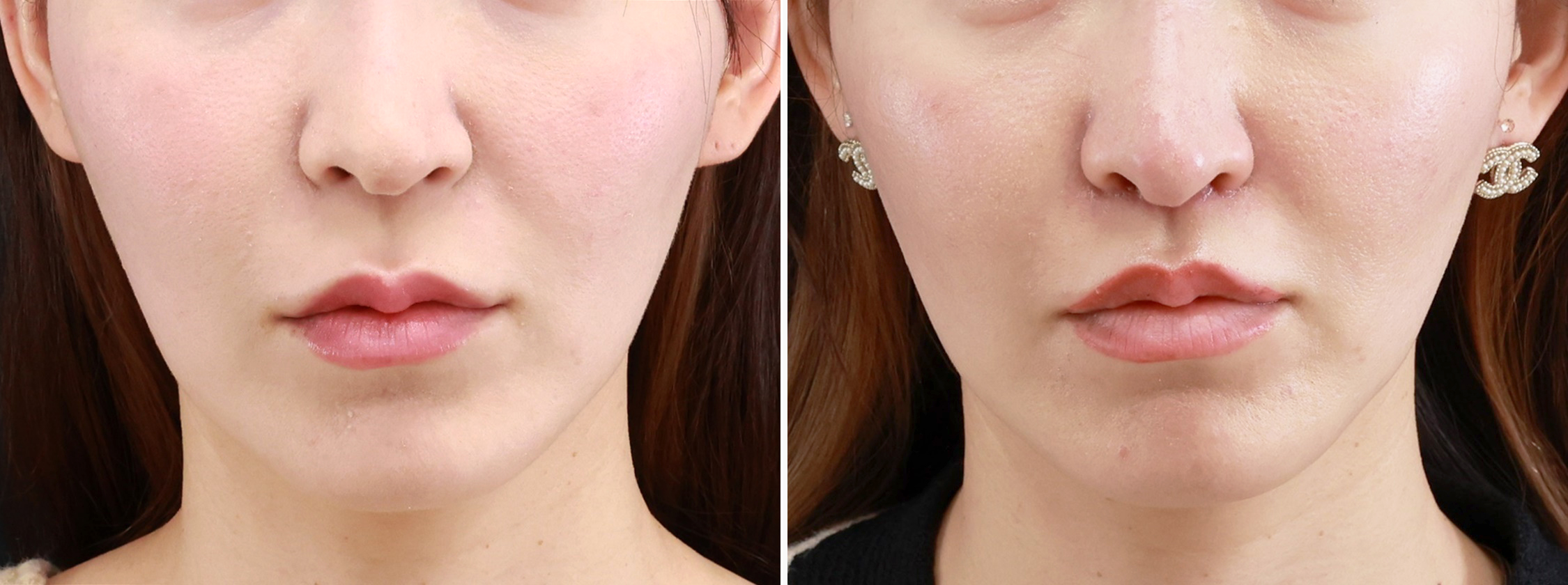 人中短縮術(リップリフト)・外側人中短縮術の症例写真 施術前後 1ヵ月