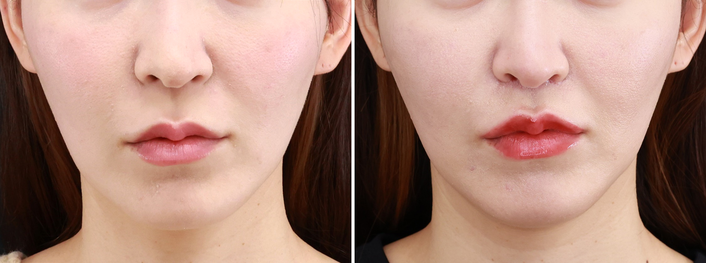 人中短縮術(リップリフト)・外側人中短縮術の症例写真 施術前後 3ヵ月