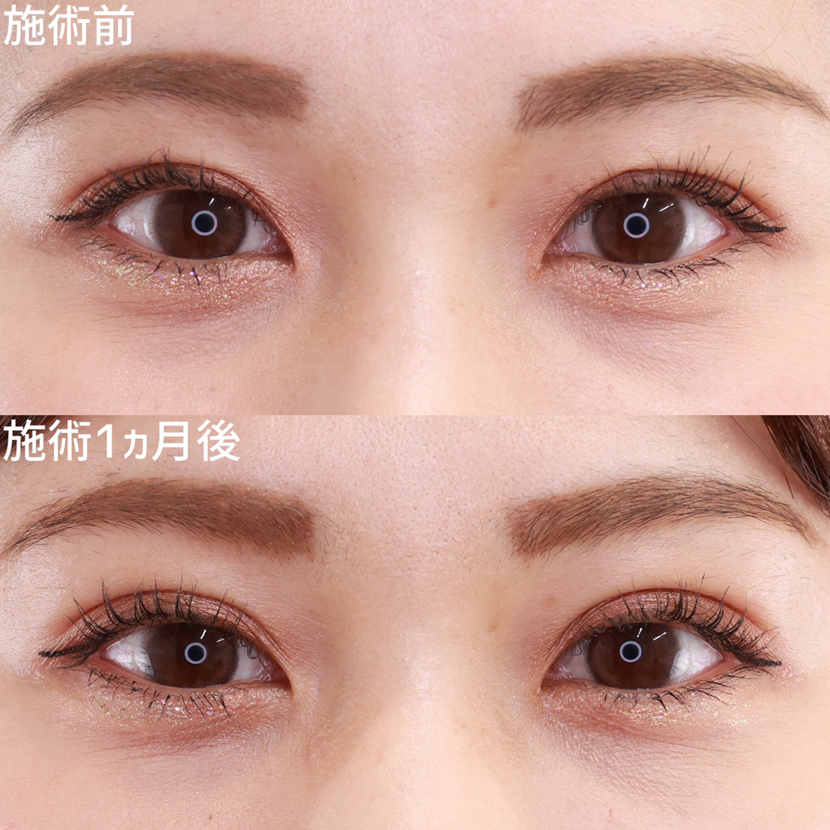 二重埋没法の症例写真 施術前後 