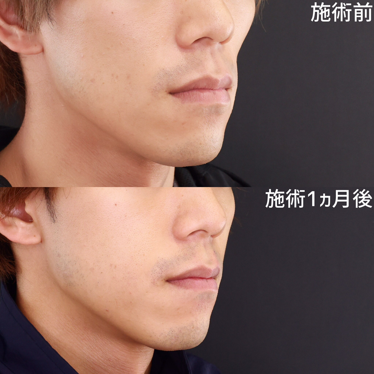 頬の脂肪注入で、健康的な印象をGET！