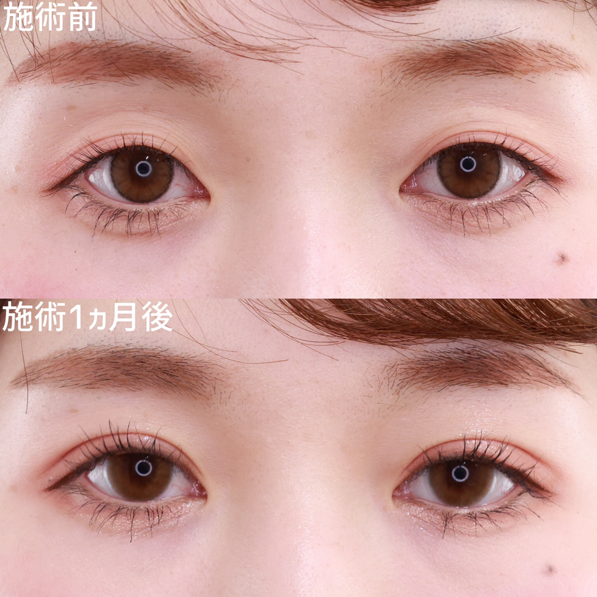 埋没法で薄かった二重ラインをしっかりと強調して存在感◎！！