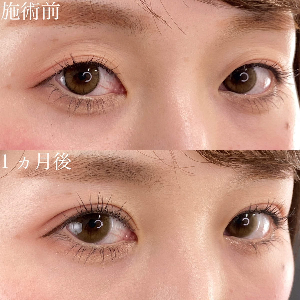 二重埋没法/目元：その他の症例写真 施術前後 