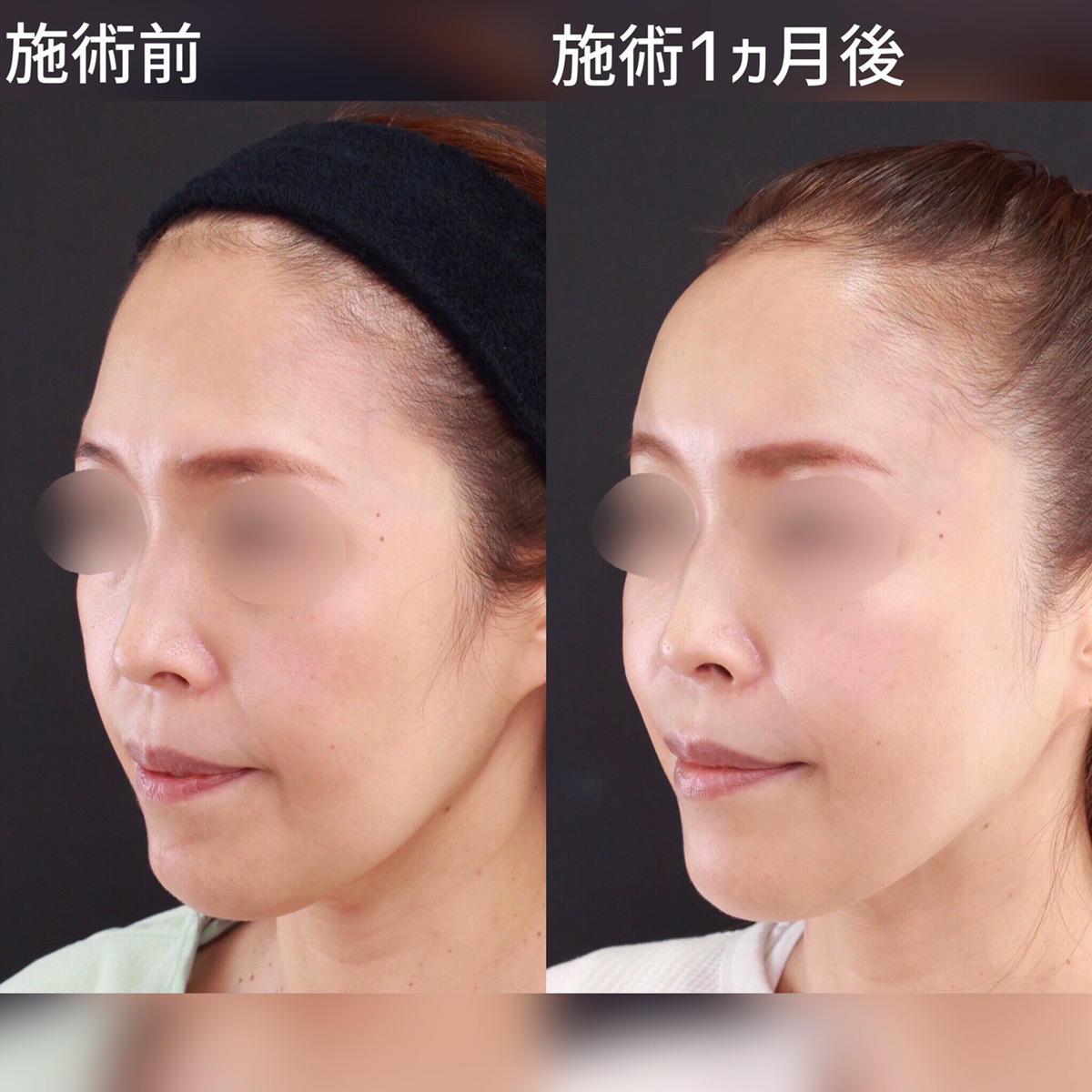 どの角度から見られても大丈夫！複合施術で自信の持てる輪郭に