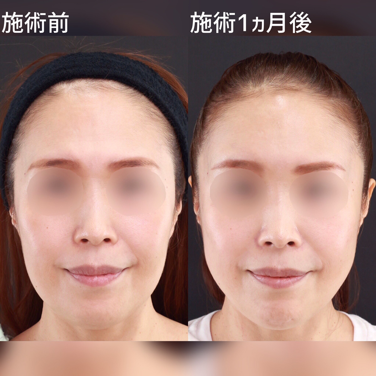 TAC式 ツヤ肌コラーゲンリフト®/おでこの脂肪注入（オルチャンデコ形成）の症例写真 施術前後 