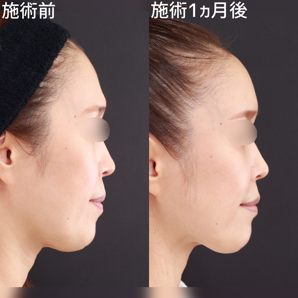 TAC式 ツヤ肌コラーゲンリフト®/おでこの脂肪注入（オルチャンデコ形成）の症例写真 施術前後 