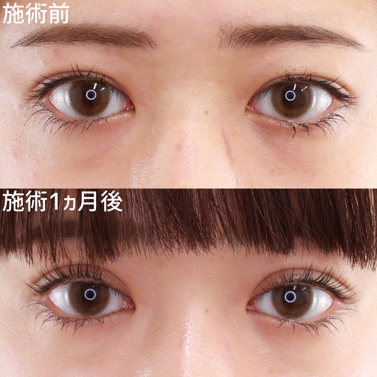 埋没法で幅を広げ、グッと引き込まれるような二重に