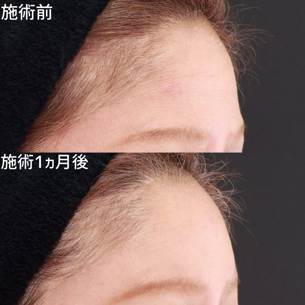 額の脂肪注入で自然なおでこ美人に