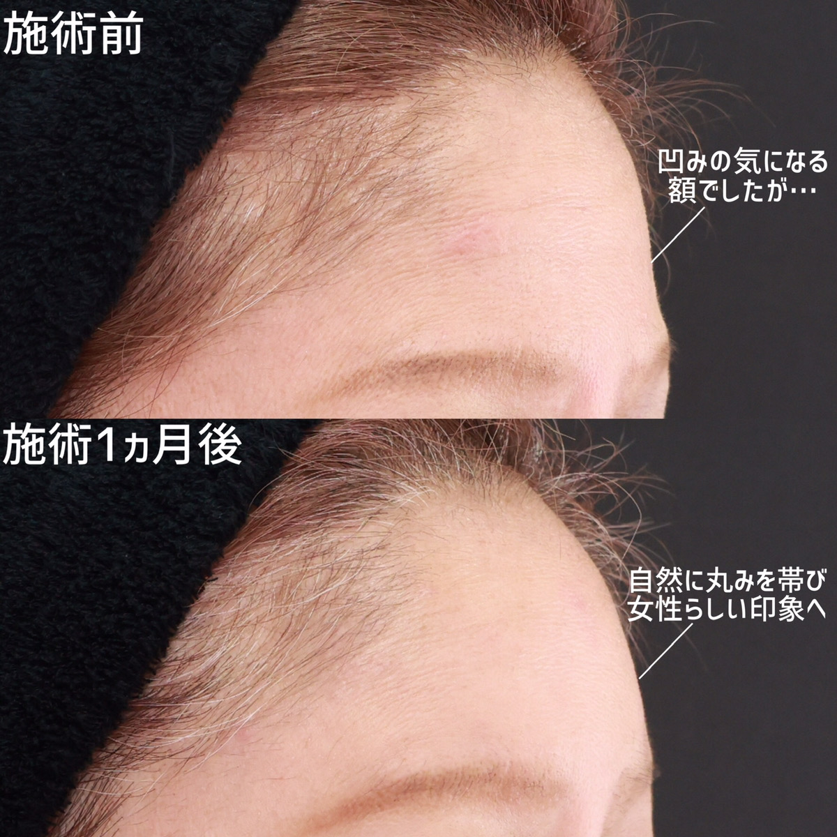 おでこの脂肪注入（オルチャンデコ形成）の症例写真 施術前後 