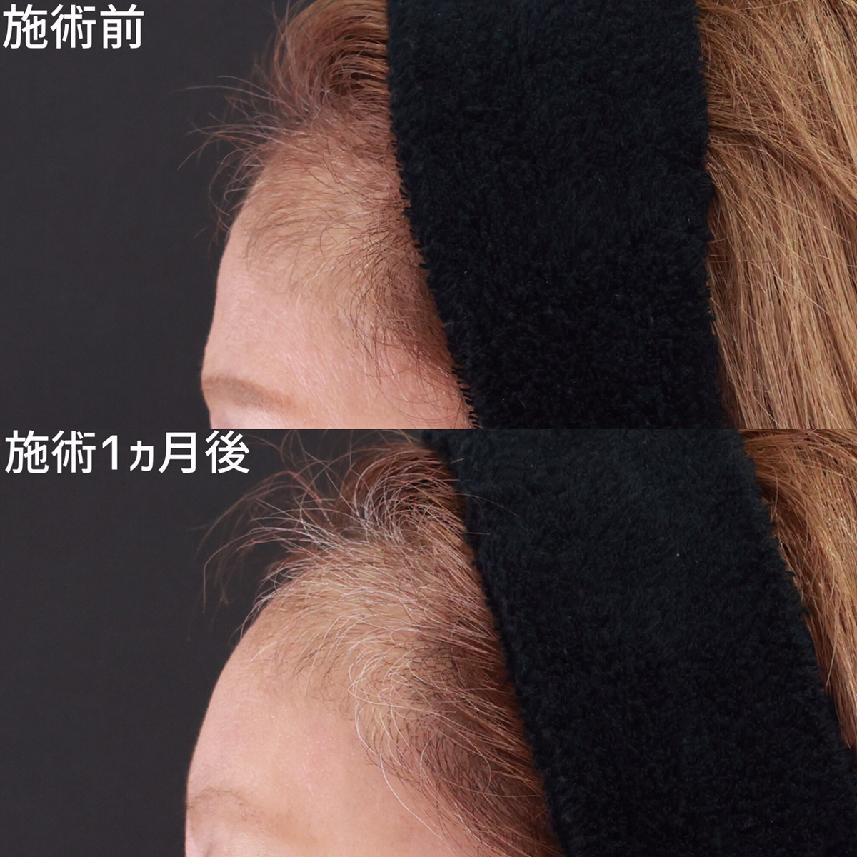 おでこの脂肪注入（オルチャンデコ形成）の症例写真 施術前後 