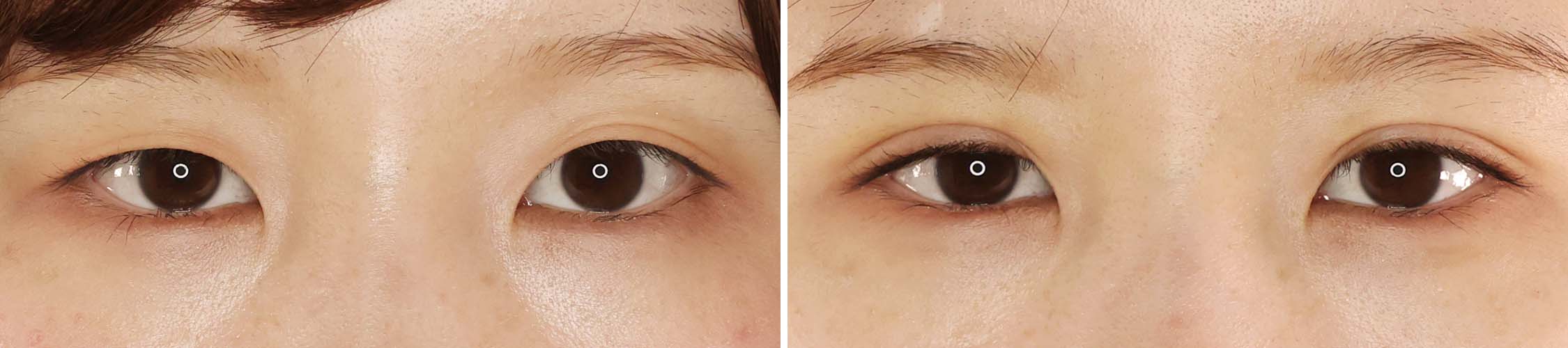 左右対称の美しい二重を切らずに手に入れる！！【二重埋没法】