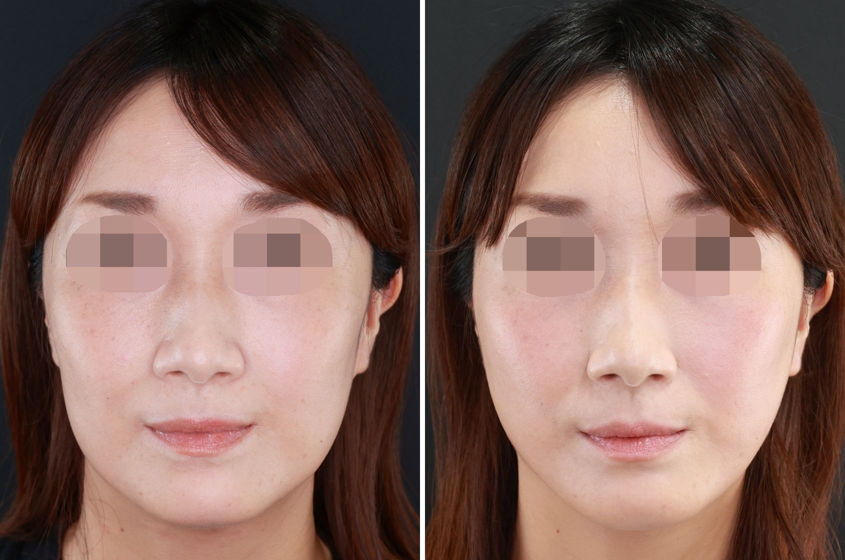 TAC式ツヤ肌コラーゲンリフトと脂肪除去でスッキリとしたフェイスラインに