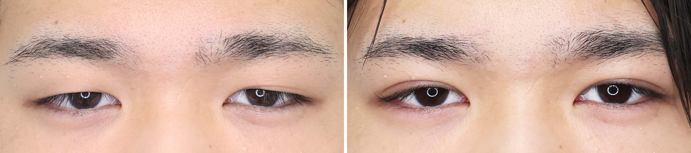 短いダウンタイムでメンズの厚いまぶたもしっかり二重に