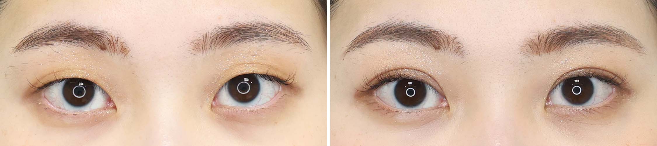 二重埋没法の症例写真 施術前後 １ヵ月