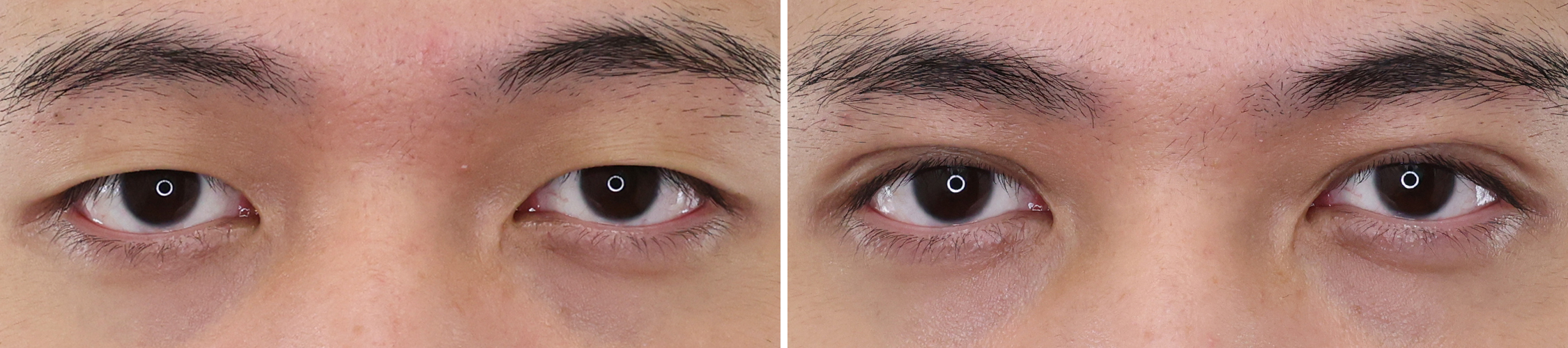 頑固な一重、卒業！！ TAC式二重埋没法でパッチリ二重に