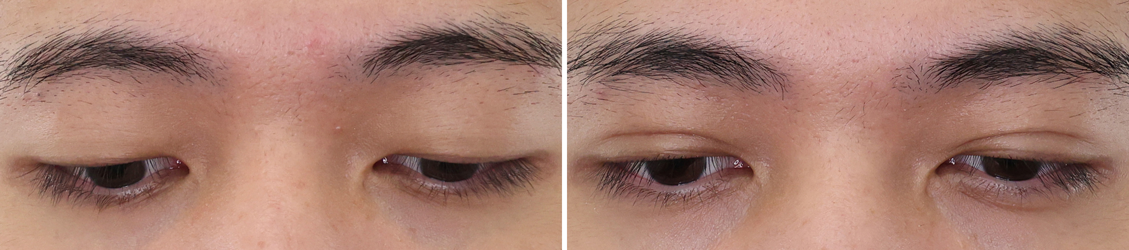 二重埋没法の症例写真 施術前後 １ヵ月