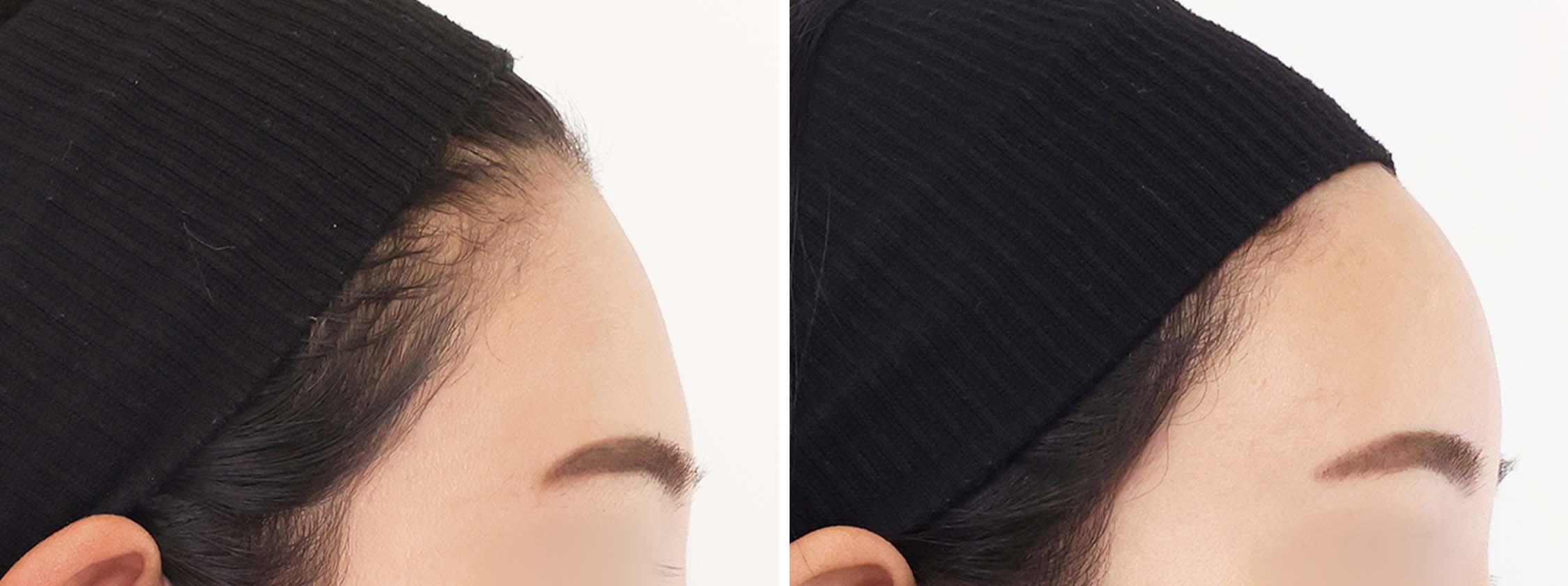 おでこの脂肪注入（オルチャンデコ形成）の症例写真 施術前後 １ヵ月