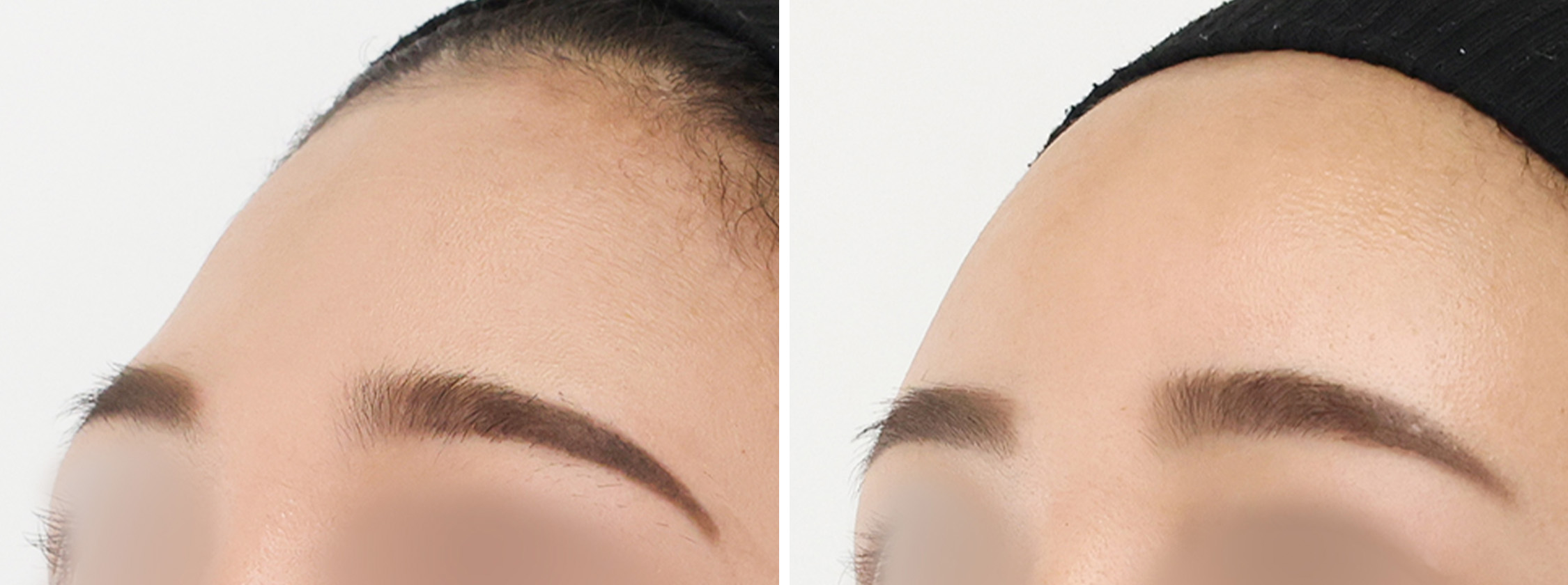 おでこの脂肪注入（オルチャンデコ形成）の症例写真 施術前後 １ヵ月