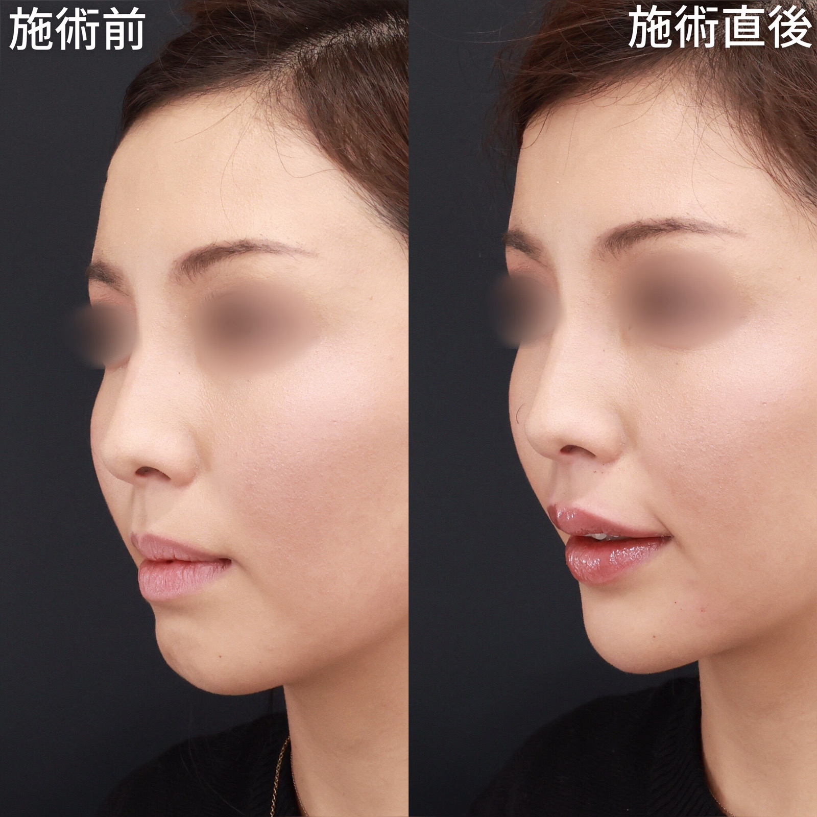 顎のヒアルロン酸注射/ヒアルロン酸注射:その他/ボトックス注射:その他の症例写真 施術前後