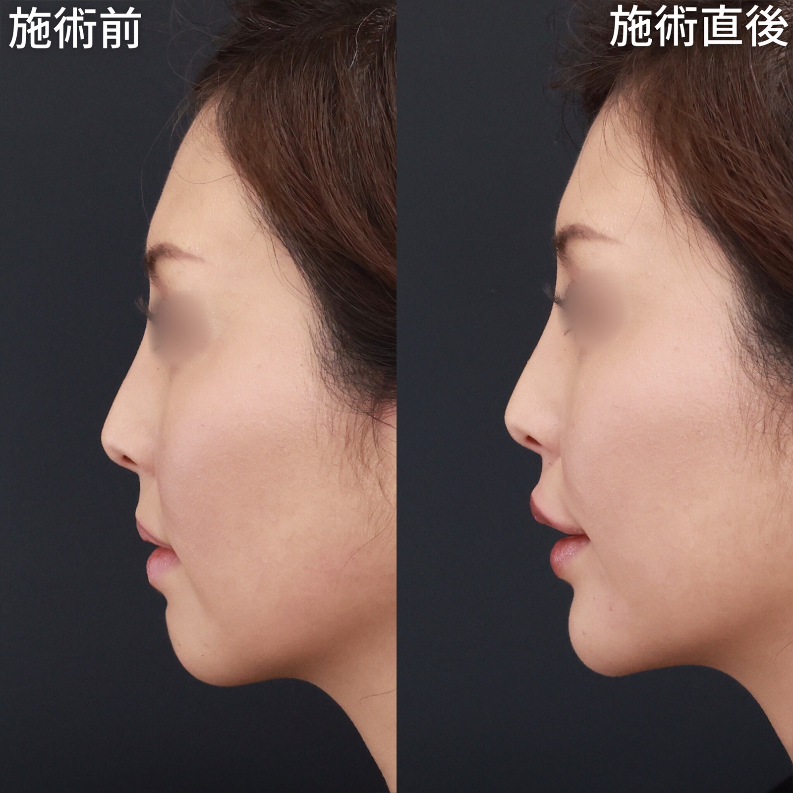 顎のヒアルロン酸注射/ヒアルロン酸注射:その他/ボトックス注射:その他の症例写真 施術前後