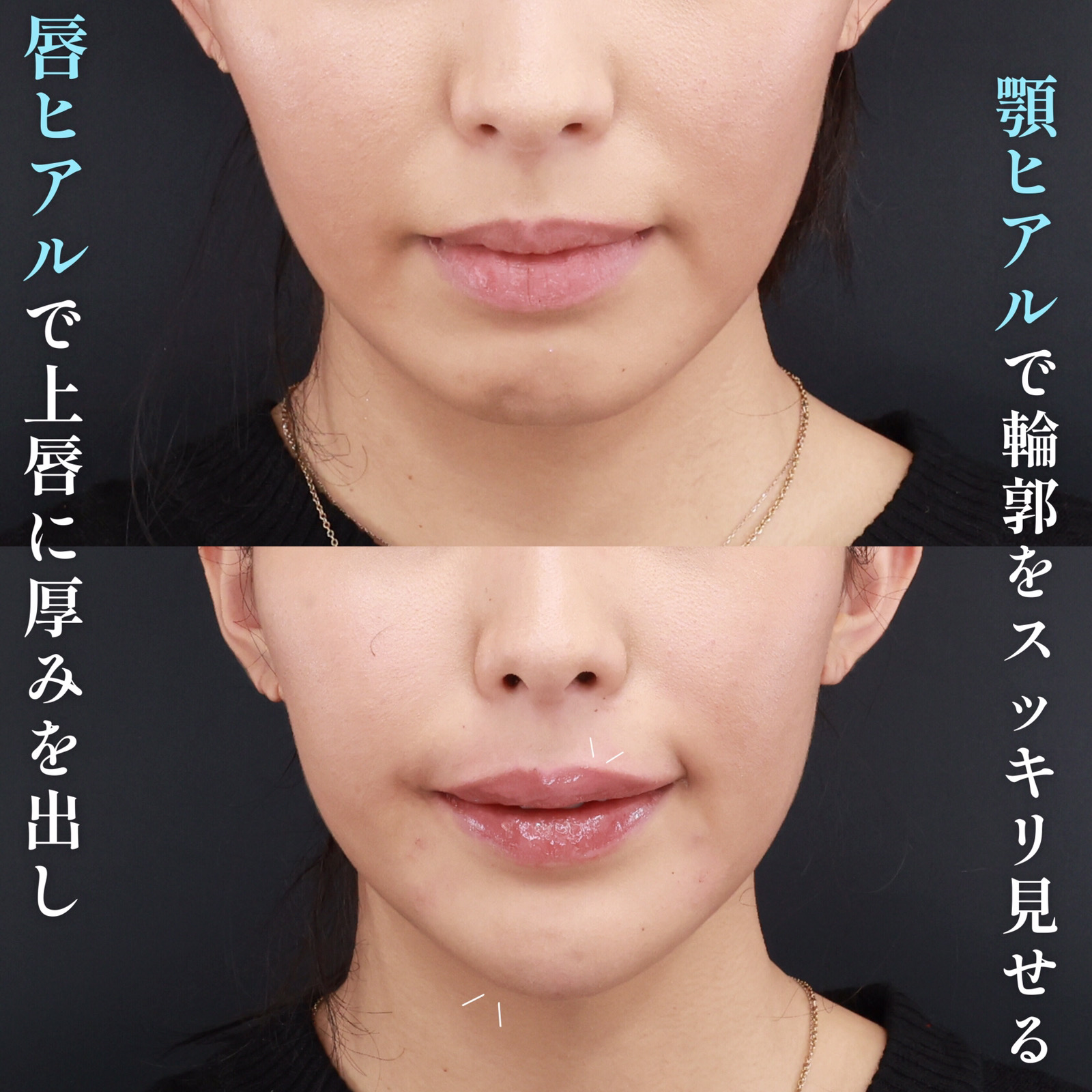 顎のヒアルロン酸注射/ヒアルロン酸注射:その他/ボトックス注射:その他の症例写真 施術前後
