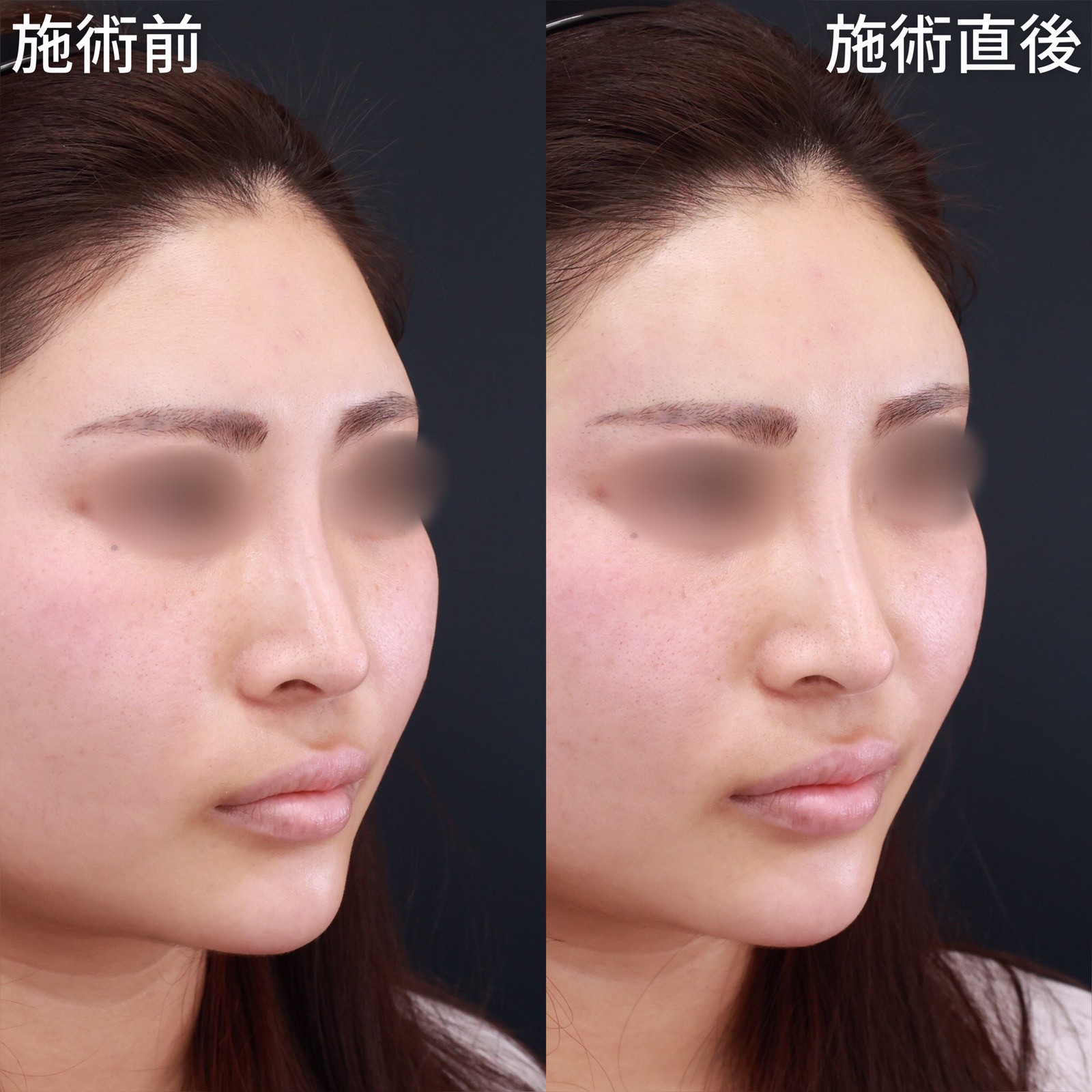 おでこ・こめかみのヒアルロン酸注射/ヒアルロン酸注射：その他の症例写真 施術前後 