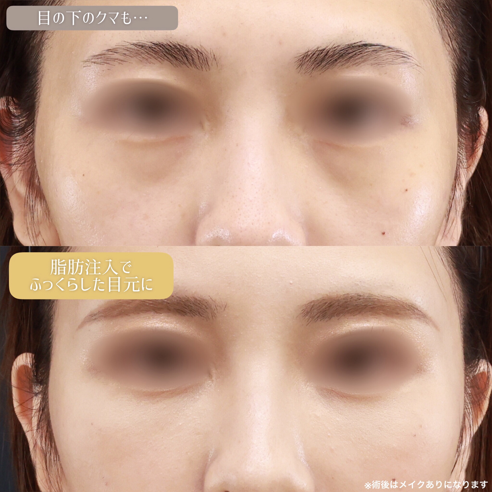 顔の脂肪注入(コンデンスリッチフェイス)/おでこの脂肪注入（オルチャンデコ形成）/下眼瞼脱脂術（目の下のたるみ取り・目の下の脂肪ふくらみ取り）の症例写真 施術前後 