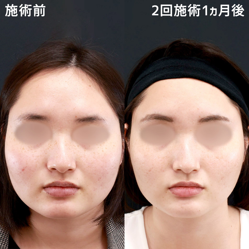 フォトシルクプラス光治療の症例写真 施術前後 