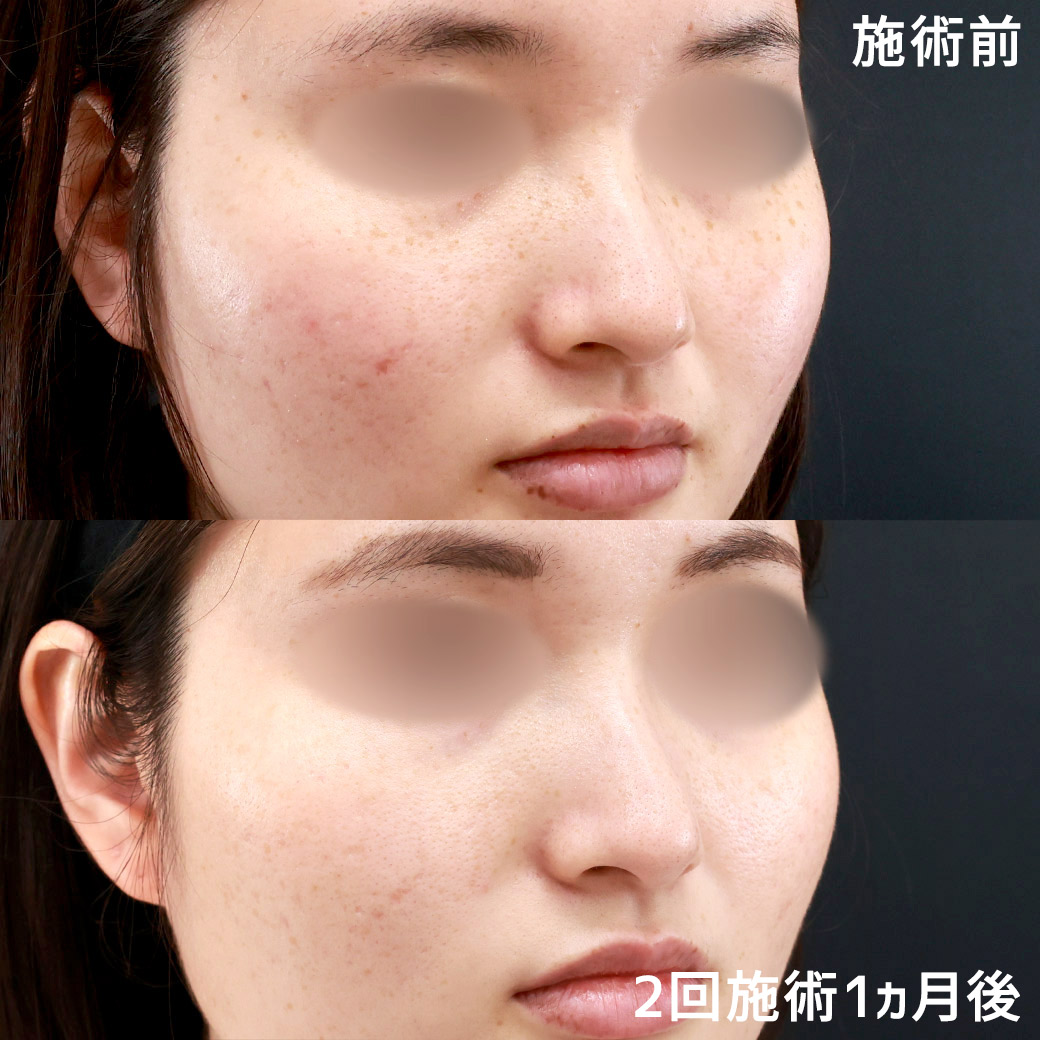 フォトシルクプラス光治療の症例写真 施術前後 