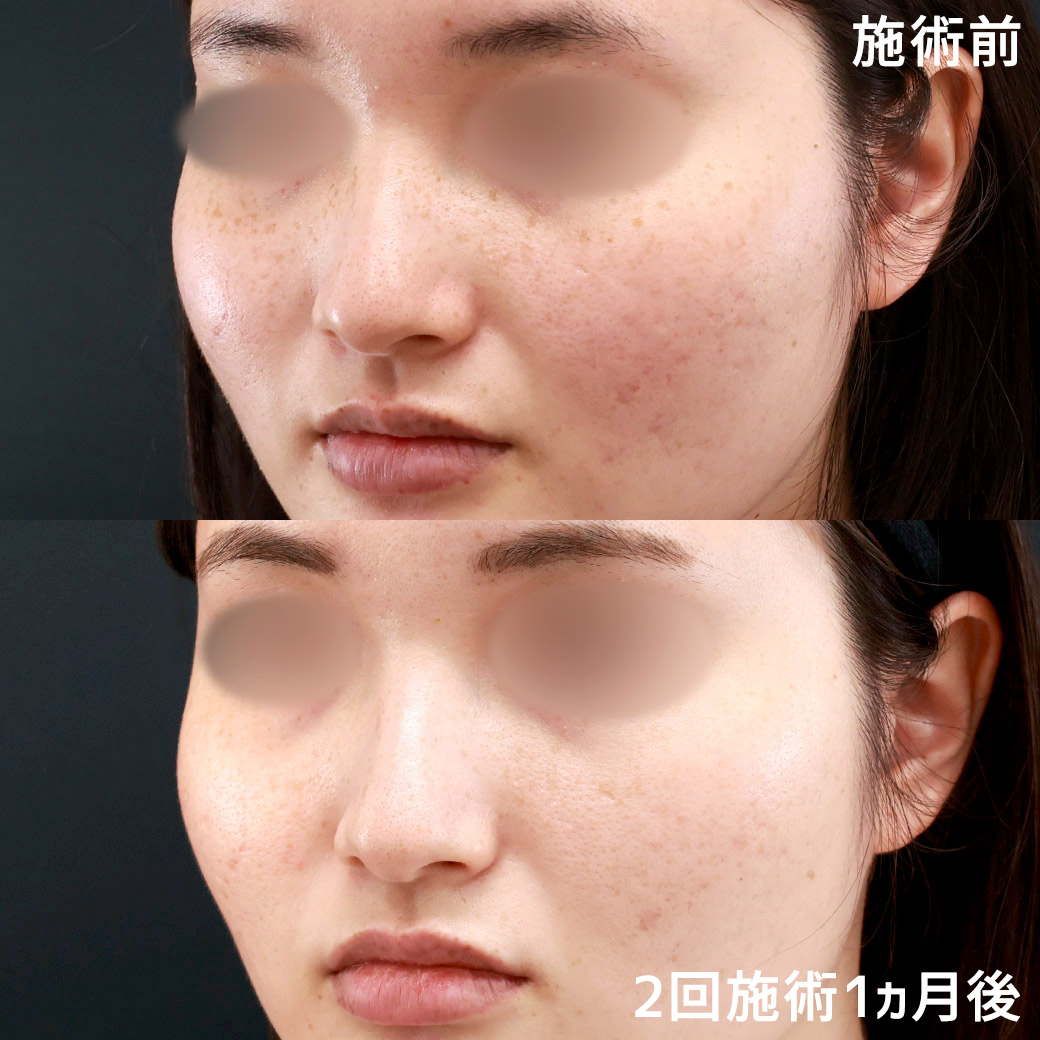 フォトシルクプラスでさらに白く美しい肌に