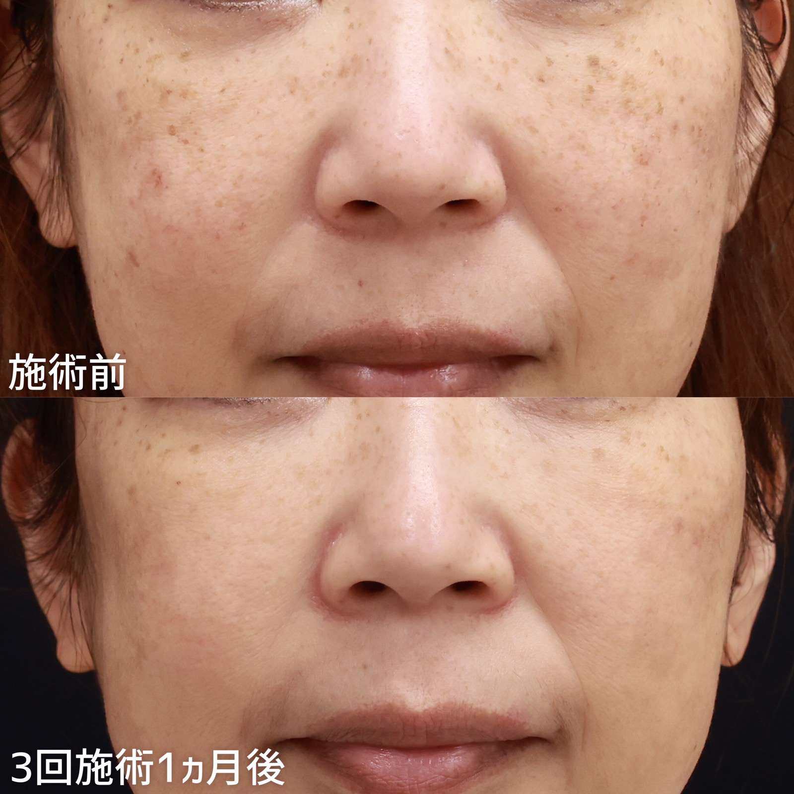 フォトシルクプラスで１度の施術でシミ激減