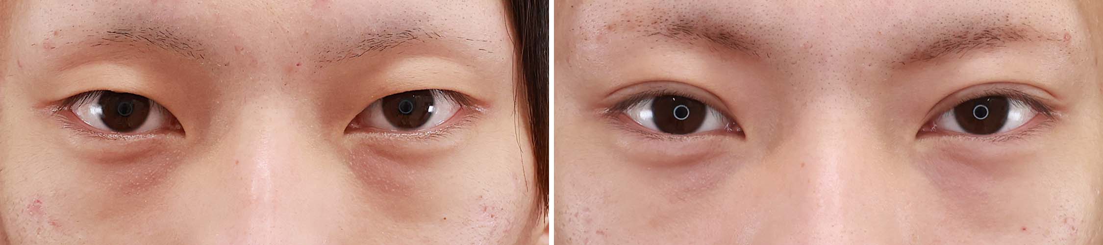 雰囲気一変！！　二重埋没法でやさしい目元を手に入れる。