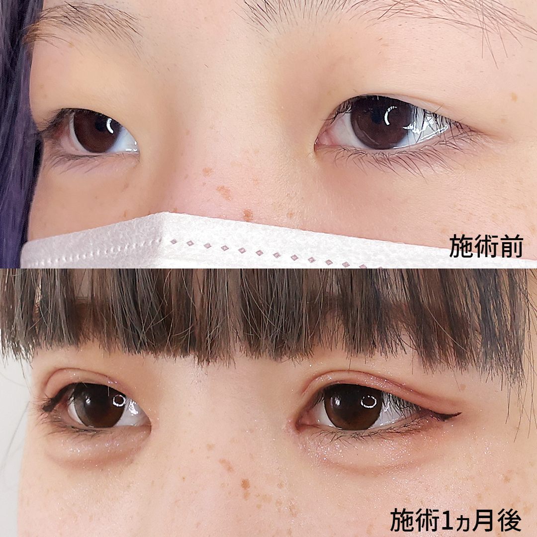 二重切開(全切開法)/目頭切開術/目尻切開術の症例写真 施術前後