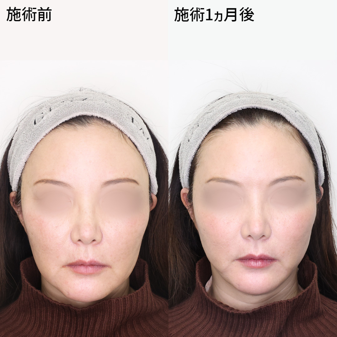 お顔の複合施術で叶う【マイナス10歳見え】