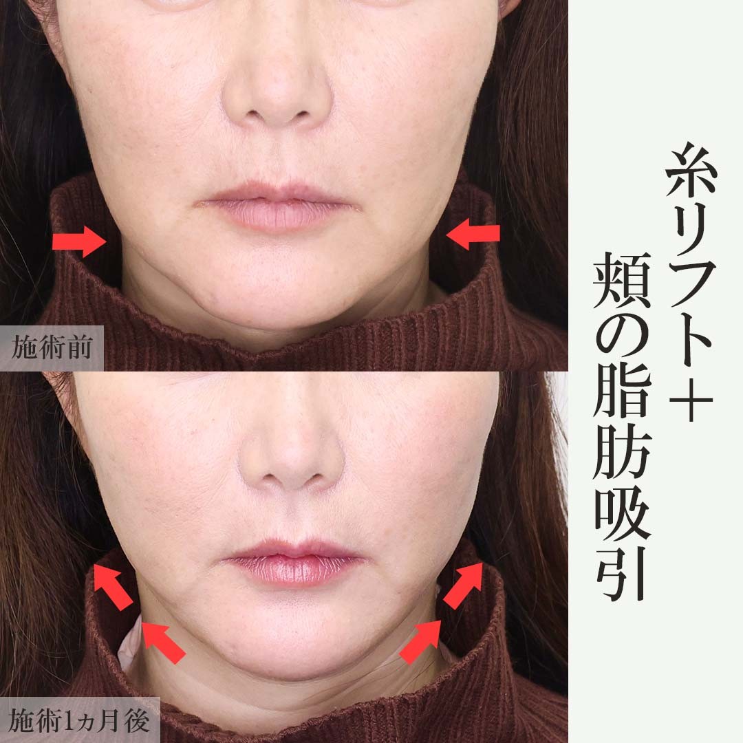 TAC式 ツヤ肌コラーゲンリフト®/ジョールファット除去/顔の脂肪吸引の症例写真 施術前後 